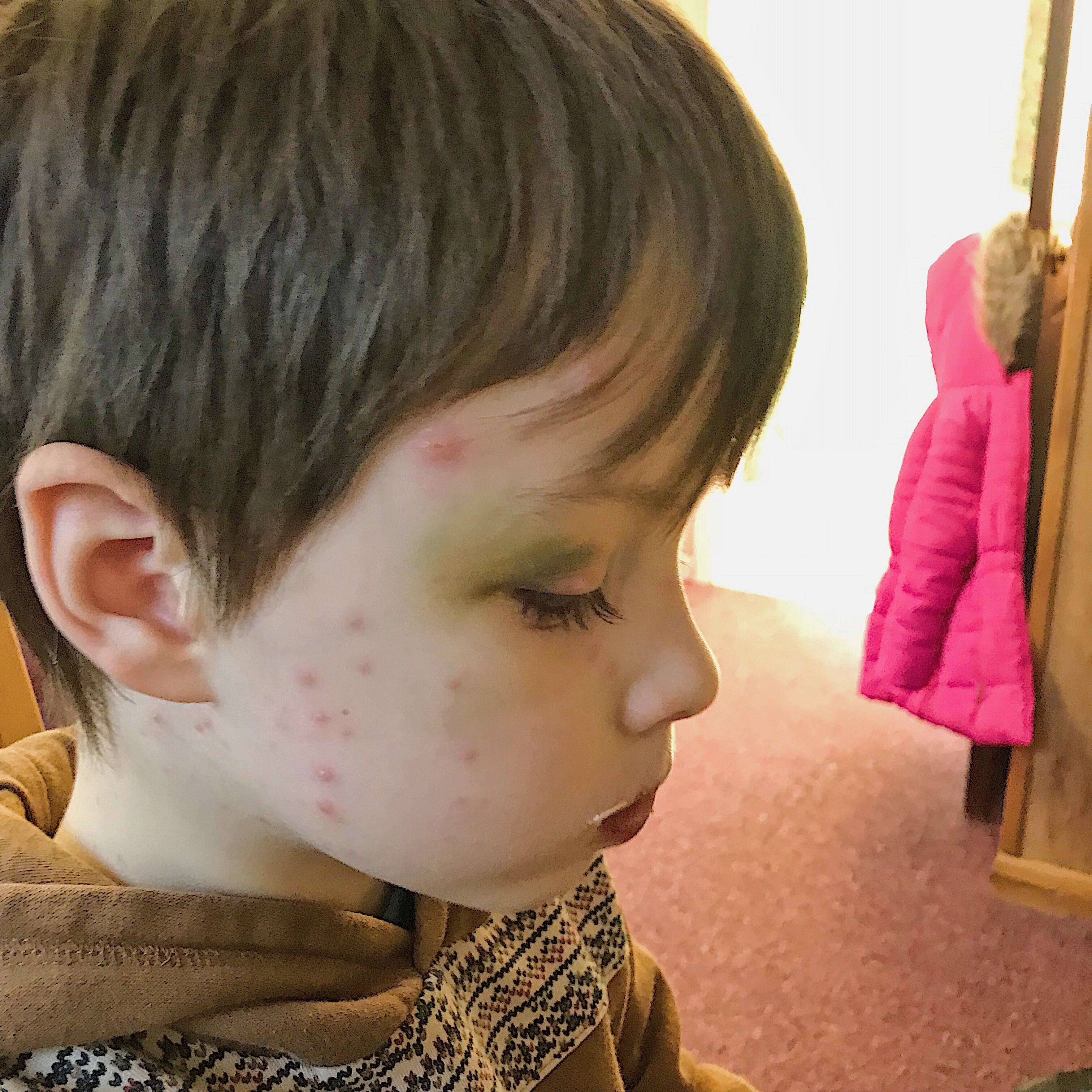 How to survive the dreaded Chicken Pox. 10 tips updated